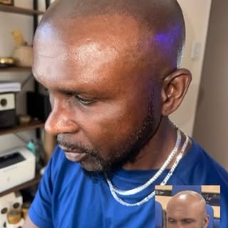 Complete Scalp Micropigmentation #scalprestore #hairdensity #hairtatoo