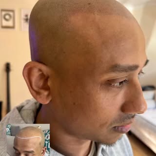 Scalp Restore By Martin #density #hairsolution #scalpmicropigmentation #scalpproblems