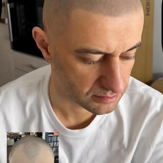 Scalp Micropigmentation in London #qualitysmp #affordablesmp #densitysmp #femalesmp #bestsmpartist