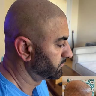 Scalp Micropigmentation #restore hairline #density #hairfoliclesimulation #baldness
