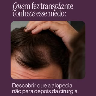 Recebo muita gente depois do transplante, assustada com os primeiros sinais de queda voltando.

Na m