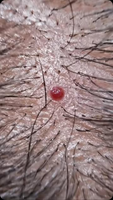 🔴 What are those tiny red spots on the skin?

They may be cherry angiomas, small clusters of blood 