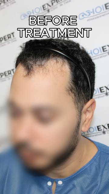 6 months after a frontal hair transplant.

At this stage, the transformation is already visible.

Th