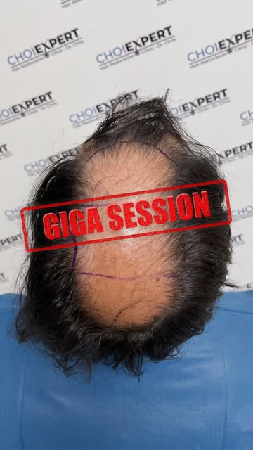GIGA SESSION | 7,000+ GRAFTS 🔥

Αυτό που συνήθως θα απαιτούσε 2–3 ξεχωριστές επεμβάσεις και κάποια 