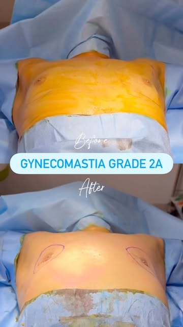 Follow @dr.sreekar.harinatha Gynecomastia is not simply excess fat.
It involves enlargement of male 
