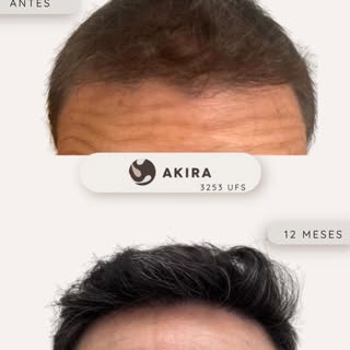 ✨ Caso real de éxito en alopecia difusa ✨

En Clínica Akira sabemos que cada paciente necesita un en