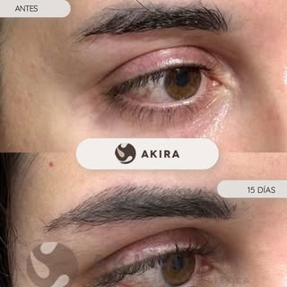 ✨Realzando miradas✨

En estas imágenes podéis ver el resultado del injerto de cejas a los 15 días de