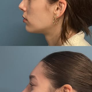 Double Board-Certified Plastic Surgeon, Dr. Malhotra, does it again! 10 months post-op and the trans