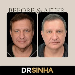 Opening up the eyes with a blepharoplasty can change the overall look of your face. This remarkable 
