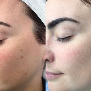 👏🏽INTENSE 👏🏽PULSE 👏🏽LIGHT 

aka IPL 🫶🏽

The above before and afters are taken 6 weeks apart 