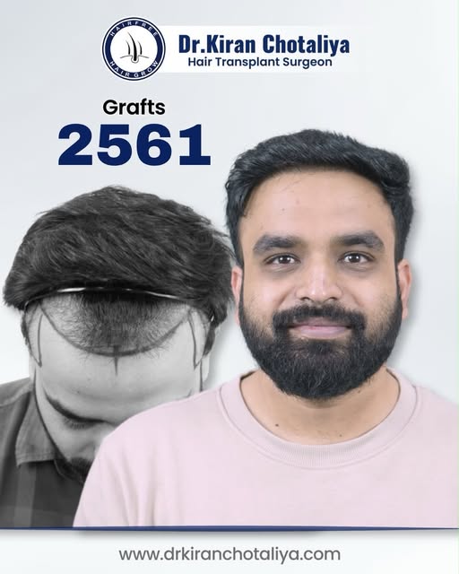 Real Results. Real Transformation. 2561 Grafts. 💇‍♂️✨

Hair loss can affect more than your appearan