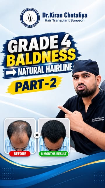Grade 4 baldness doesn’t mean you have to give up on a natural-looking hairline. 👨‍🦱✨
This transfo