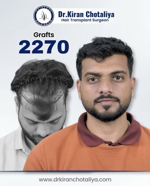 Real results. Real confidence. ✨
2270 grafts. One transformation.
Because hair restoration isn’t jus