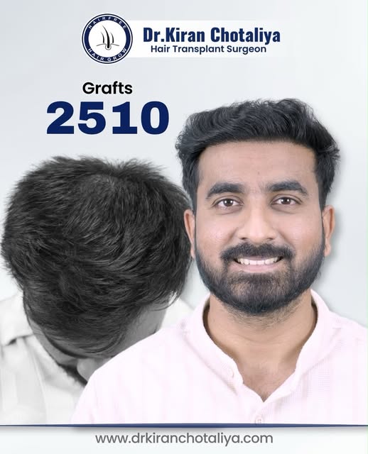 Real Results. Real Transformation. 🌱
A hair transplant isn’t just about restoring hair — it’s about