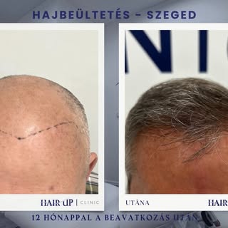 Hajbeültetés! Ez a legjobb alkalom!
 Szegeden, a Hair Up Clinic biztos döntés! 

Nézd meg páciensein