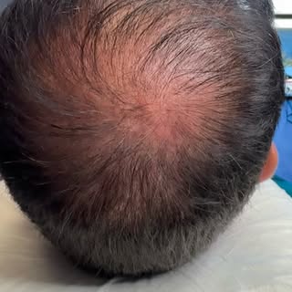 ✨ Why walk out with thinning hair when SMP can give you back your confidence? ✨

Scalp Micropigmenta