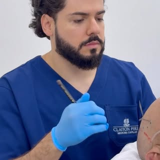 Transplante capilar não é simplesmente “colocar cabelo onde falta”.

Antes de pensar em quantidade d