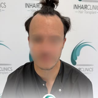 Een haartransplantatie draait niet alleen om nieuw haar.
Het draait om het herstellen van balans, ze