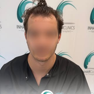 Een haartransplantatie draait niet alleen om meer haar, maar om een natuurlijke haarlijn en een resu