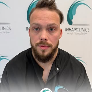 Een haartransplantatie draait niet alleen om meer haar, maar om een natuurlijke haarlijn en een resu