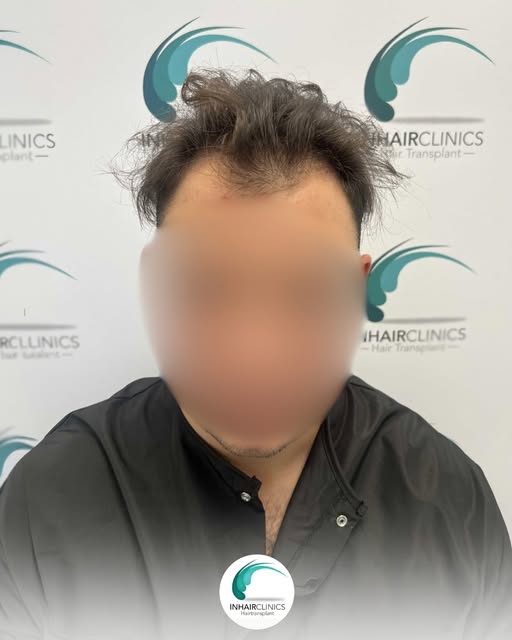 Een haartransplantatie draait niet alleen om nieuw haar.
Het draait om het herstellen van balans, ze