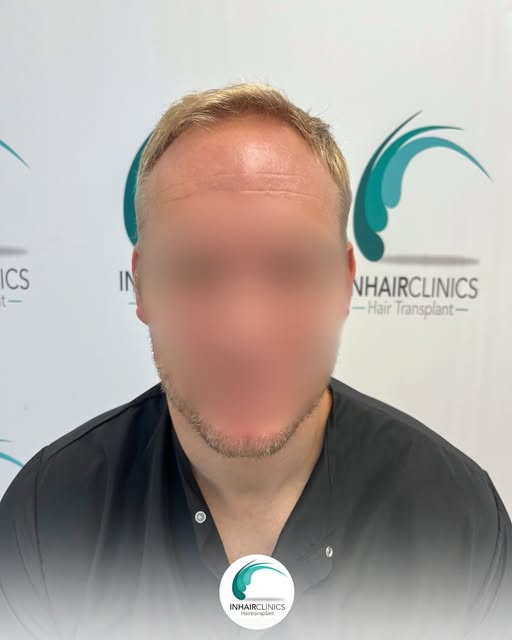 Een haartransplantatie draait niet alleen om nieuw haar.
Het draait om het herstellen van balans, ze