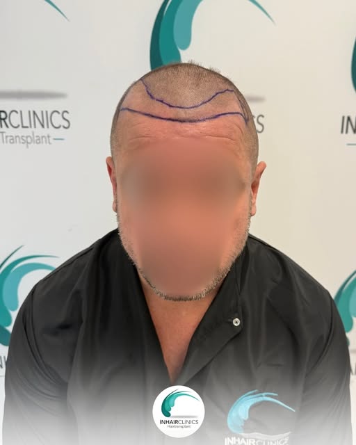 Een haartransplantatie draait niet alleen om nieuw haar.
Het draait om het herstellen van balans, ze