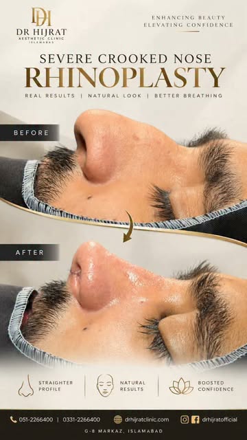 Severe Crooked Nose → Rhinoplasty ✨

A significantly deviated nose can affect both facial harmony an