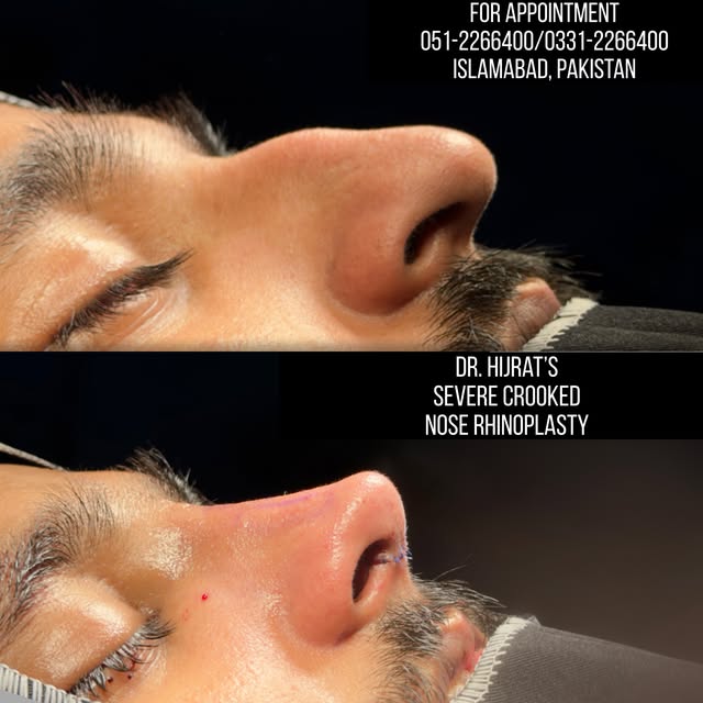 Severe Crooked Nose → Rhinoplasty ✨

A significantly deviated nose can affect both facial harmony an