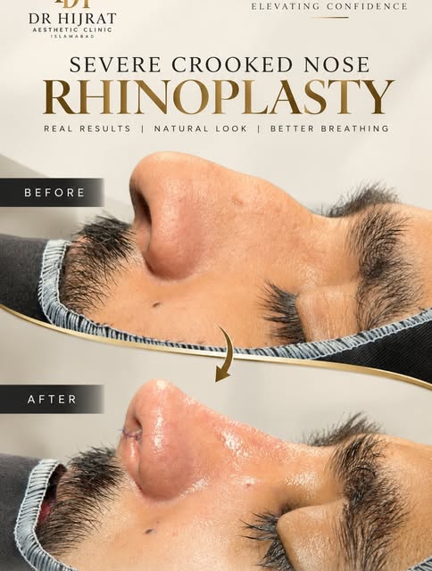 Severe Crooked Nose → Rhinoplasty ✨

A significantly deviated nose can affect both facial harmony an