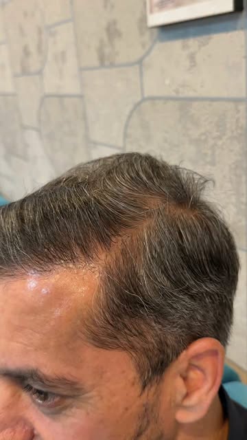 ✨ Just an Amazing Hair Transplant Result — 1.5 Years Later! ✨

Natural density, a well-designed hair