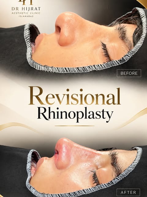 Revisional Rhinoplasty ✨

Revision rhinoplasty is more than simply reshaping the nose—it requires ca