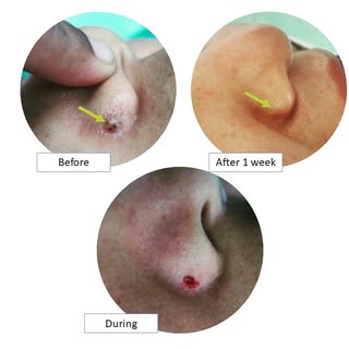 Facial Moles can be removed safely and effectively with minimum scars.