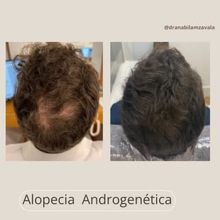 Hoy en día si se trata a tiempo una alopecia podemos mejorar y evitar su progresión; la clave pautar