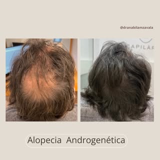 Empezamos la semana con este caso de Alopecia Androgenética masculina, se puede observar como ha mej