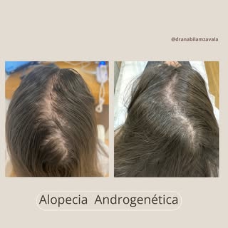 La alopecia puede ser resultado de cambios hormonales, genética, afecciones médicas o parte del enve