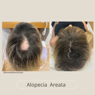 Este es el caso de una paciente de 35 años acudió a consulta con diagnóstico de alopecia areata, una