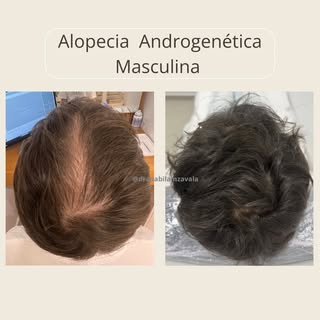Este es el caso de un hombre de 30 años de edad con adelgazamiento progresivo, el objetivo era mejor
