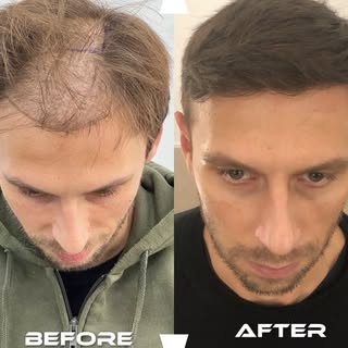 The difference is visible. The planning behind it isn’t.

A natural hair transplant result begins lo