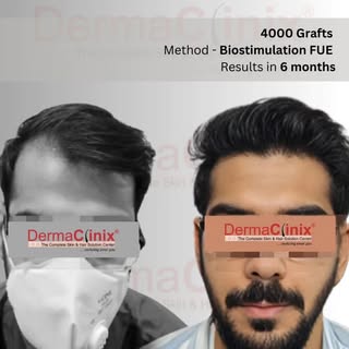 Hair Transformation at DermaClinix with 3000 graft implantation via biostimulation FUE Method.

With