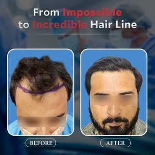 ✨ From Impossible to Incredible! ✨
Witness this life-changing transformation – 𝟮𝟳𝟬𝟬 𝗴𝗿𝗮𝗳𝘁𝘀