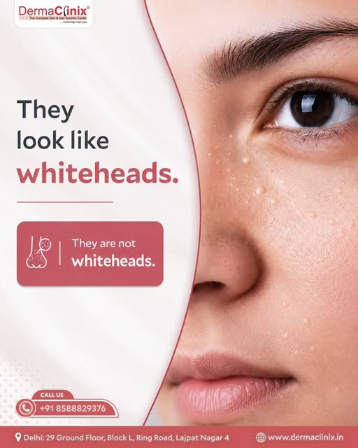They may look like whiteheads, but milia are not whiteheads. 👀

These tiny, firm bumps are keratin-