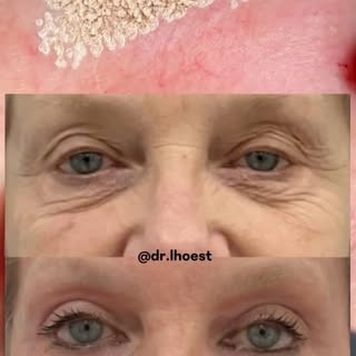 ✨ Regard rajeuni, naturel, sans chirurgie

Résultat d’une blépharoplastie médicale des paupières sup