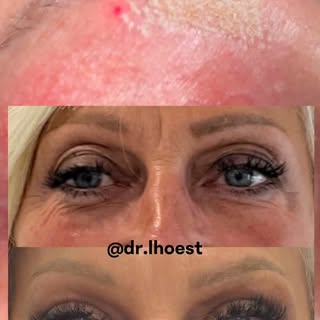 ✨ Regard rajeuni, naturel, sans chirurgie

Résultat d’une blépharoplastie médicale des paupières sup