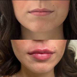 Injection lèvres  chez @lhoest.clinic 💉👄

Chez notre magnifique patiente, désireuse d’un résultat 