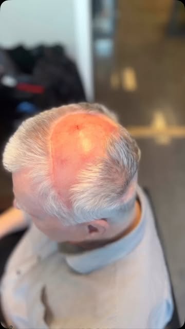 Hårtap etter strålebehandling

Strålebehandling kan føre til håravfall i strålingsområdet. Dette kan