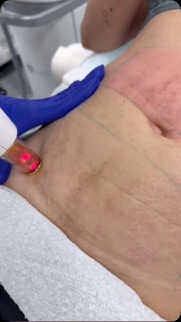 ✨ RECUPERA LA APARIENCIA DE TU PIEL DESPUÉS DEL EMBARAZO ✨

Después del embarazo, la piel del abdome