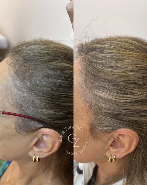 Para muitas mulheres, perceber o cabelo ficando mais ralo mexe também com a autoestima…

Esse antes 