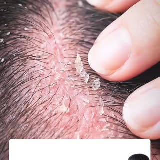 Demodex-Milben gehören zur natürlichen Hautflora und leben bei den meisten Menschen in den Haarfolli