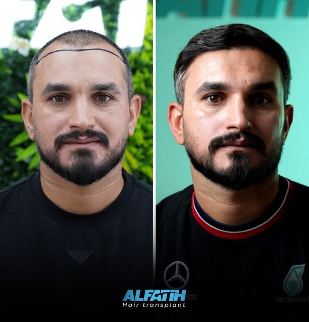 بعد زراعة الشعر في مركز الفاتح الدولي فرع العراق بغداد 
للتواصل معنا عبر الوا تساب 

⁠￼https://wa.me